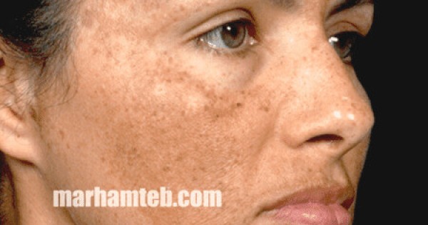 درمان لکه های پوستی در طب سنتی