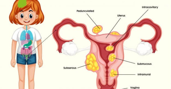 کپسول پونیکا و درمان بیماری های شایع در زنان
