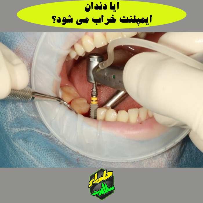 عمر دندان ایمپلنت